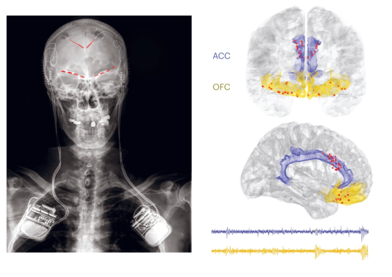 Left: An x-ray showing where electrode leads are placed in the brain and where the recording device was implanted near the shoulders. Right, top: A representation of a frontal view of the brain where the ACC is colored in blue, the OFC is colored in yellow, and red dots show where electrode leads were placed. Right, bottom: A side view of the brain with the same color-scheme. Below it are lines that are raw recorded data from the implanted electrodes. The ACC line is blue and the OFC line is yellow.