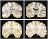 Brain cross-sections show abnormalities associated with CTE (top) compared to a control (bottom)