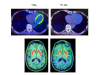 PET scans of heart and brain in Parkinson's