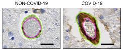 Images of blood vessels in the brain show increased levels of the adhesion molecule PECAM-1 on endothelial cells in brain tissue from patients who died from COVID-19