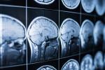 Multiple MRI images of the brain 