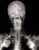 X-ray image of patient with deep brain stimulation electrodes implanted