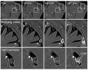 MRI tracer (white) is seen to slip through the arachnoid barrier around blood vessels connecting the brain to its covering membrane, the dura mater."