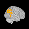 MRI scan of a brain with regions colored yellow.