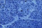 sensory nerve biopsy_GAN gene therapy