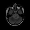 MRI image of a patient with a brain tumor