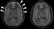 Evidence of repair after head injury in humans