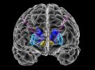 brain scan showing implanted electrodes for DBS therapy