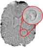 Example brain scan used in NIH study of multiple sclerosis.