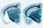 ApoE4 brain with significant degeneration