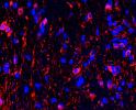 Picture of red and blue spots representing vision-threatening optic nerve gliomas on a black background.