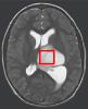 Brain scan of diffuse intrinsic pontine glioma examined in this study.