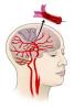 Illustration of an ischemic stroke, which occurs when a brain blood vessel gets blocked. The gray area represents brain tissue that is not receiving nutrients as a result of the stroke.