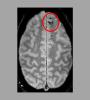 MRI scan of human brain showing tarumatic microbleeds