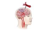 diagram of an ischemic stroke