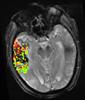 This image combines pre- and post-treatment scans from the same patient. Analysis of the two scans revealed that the area and size of post-treatment bleeding corresponded to blood-brain barrier disruption (shown in green, yellow and red) prior to therapy