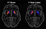 image of two brains from a parkinson's patient: 1 initial scan and another from 1 year later